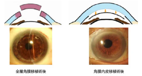 図4 角膜移植のシェーマと移植後の前眼部写真
