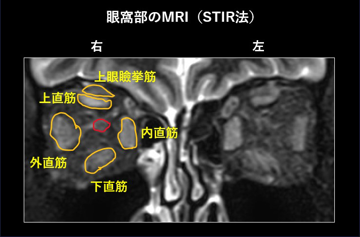 眼窩部のMRI（STIR法）