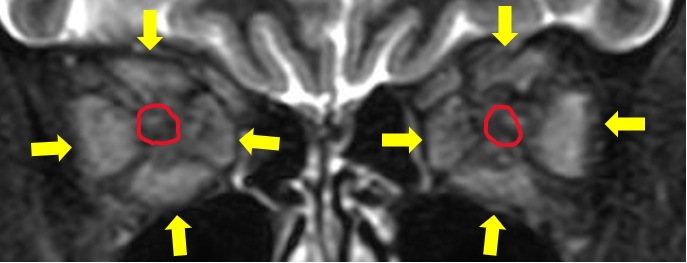 重篤化した症例の眼窩部MRI