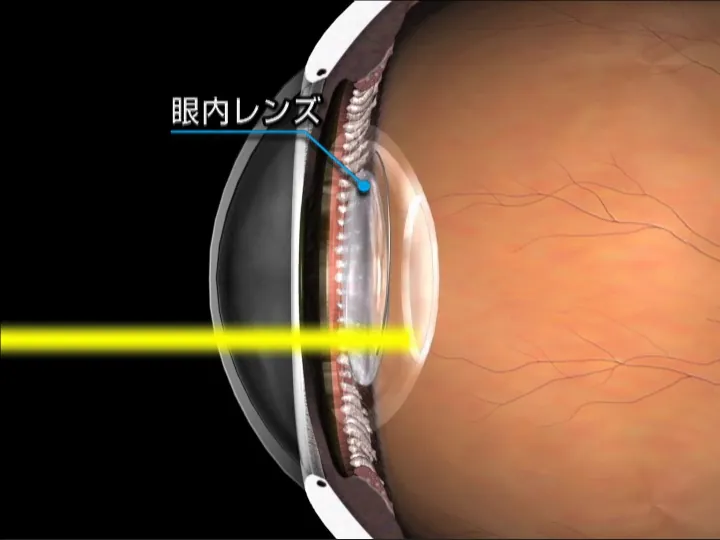 後発白内障レーザー治療