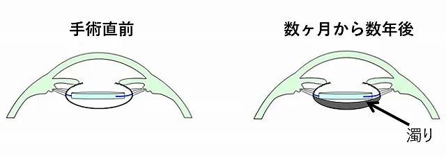 後発白内障