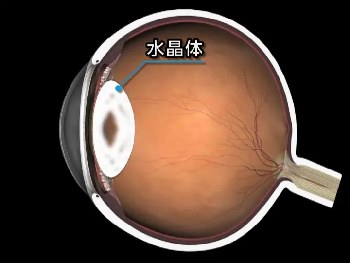 白内障は目の水晶体が白く濁る病気