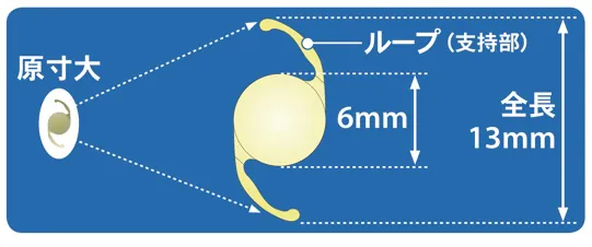 濁った水晶体の代わりとなる人工水晶体です。